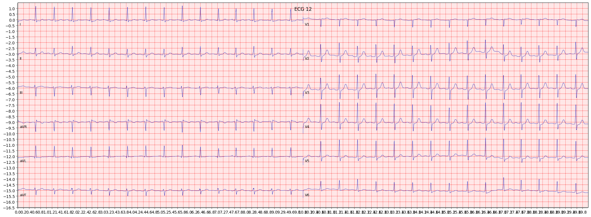 non-diagnostic T abnormalities (NDT) example 408