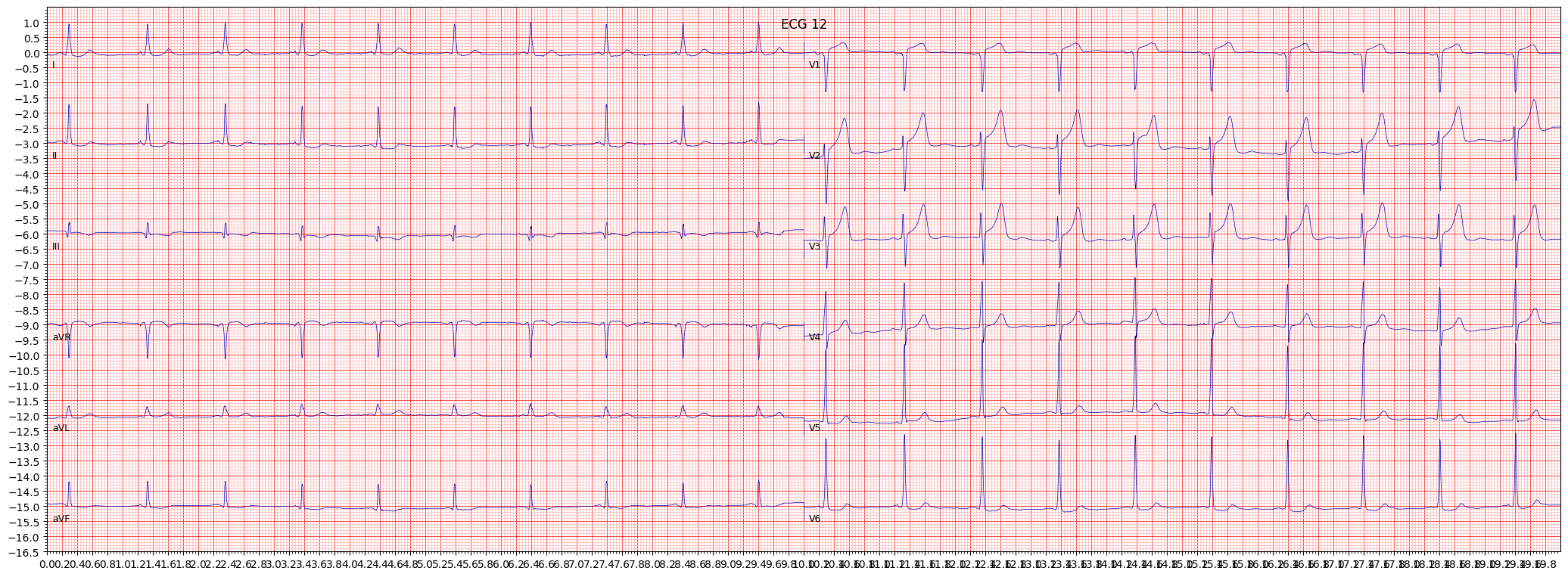 ischemic in inferolateral leads (ISCIL) example 4085