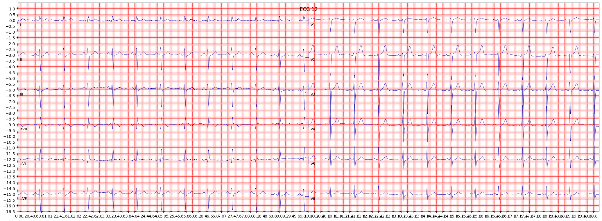 left anterior fascicular block (LAFB) example 41