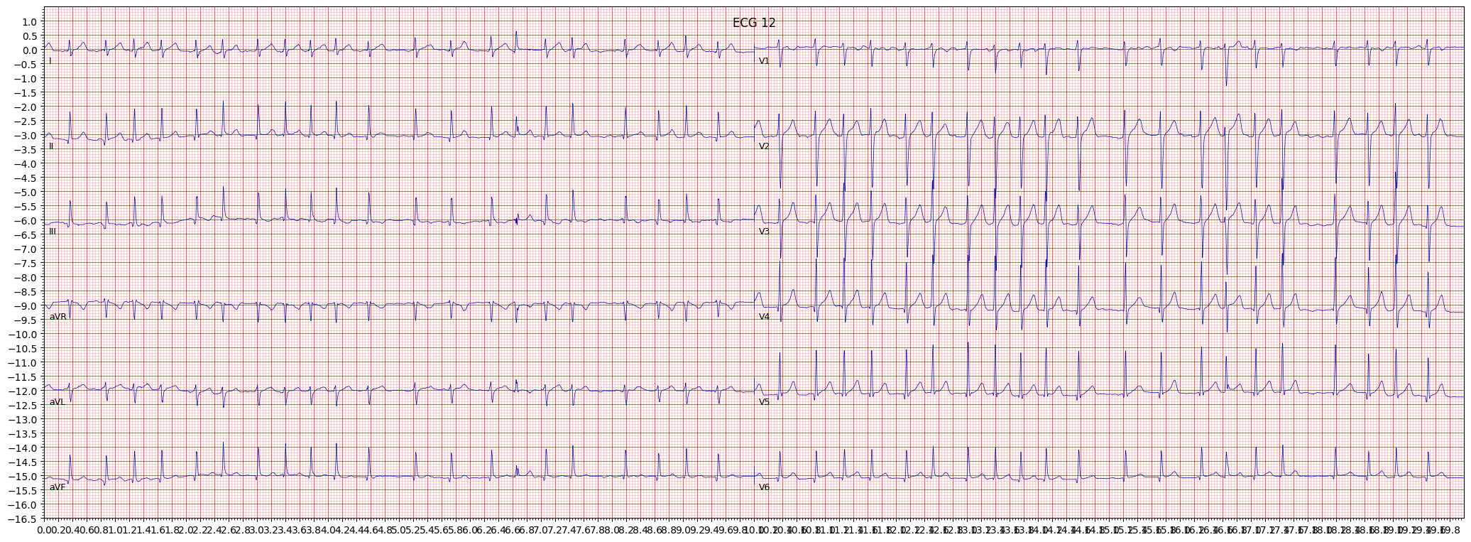 atrial fbrillation (AFIB) example 4117