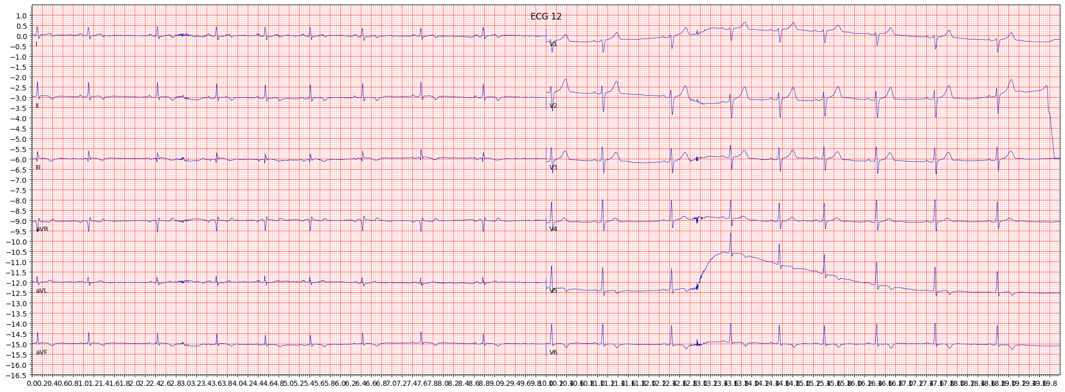 ischemic in inferolateral leads (ISCIL) example 416