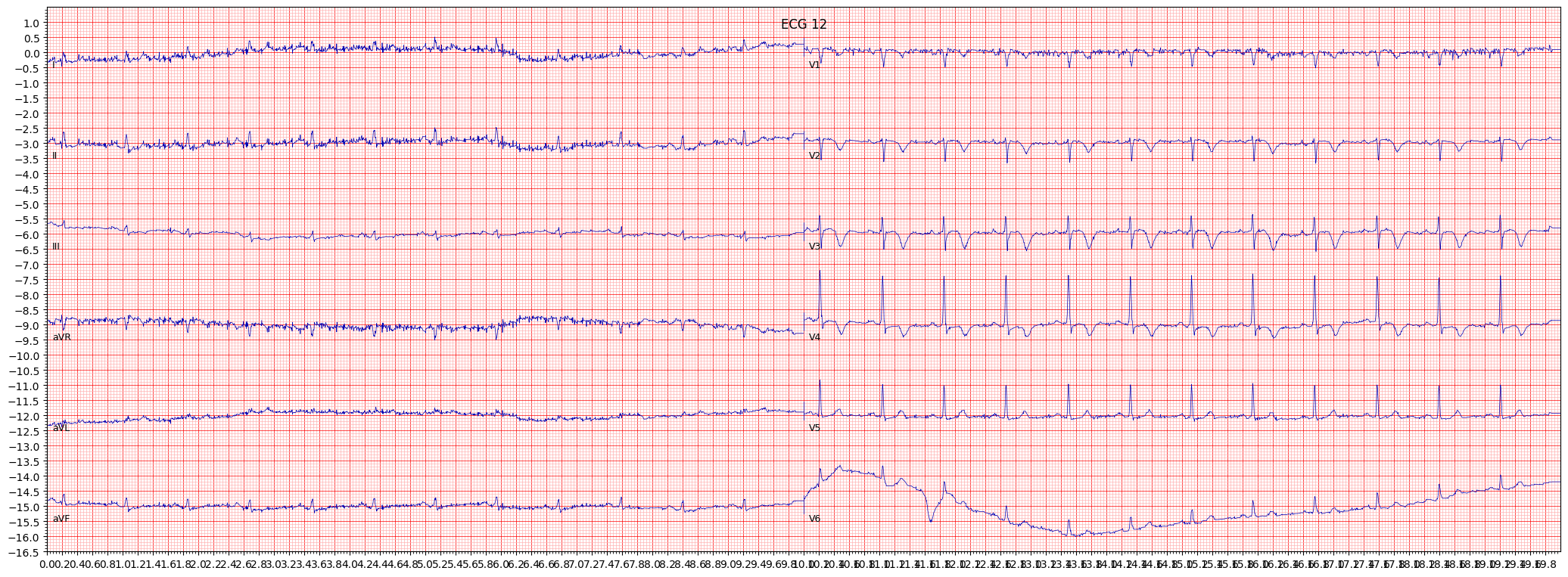 subendocardial injury in anteroseptal leads (INJAS) example 4175