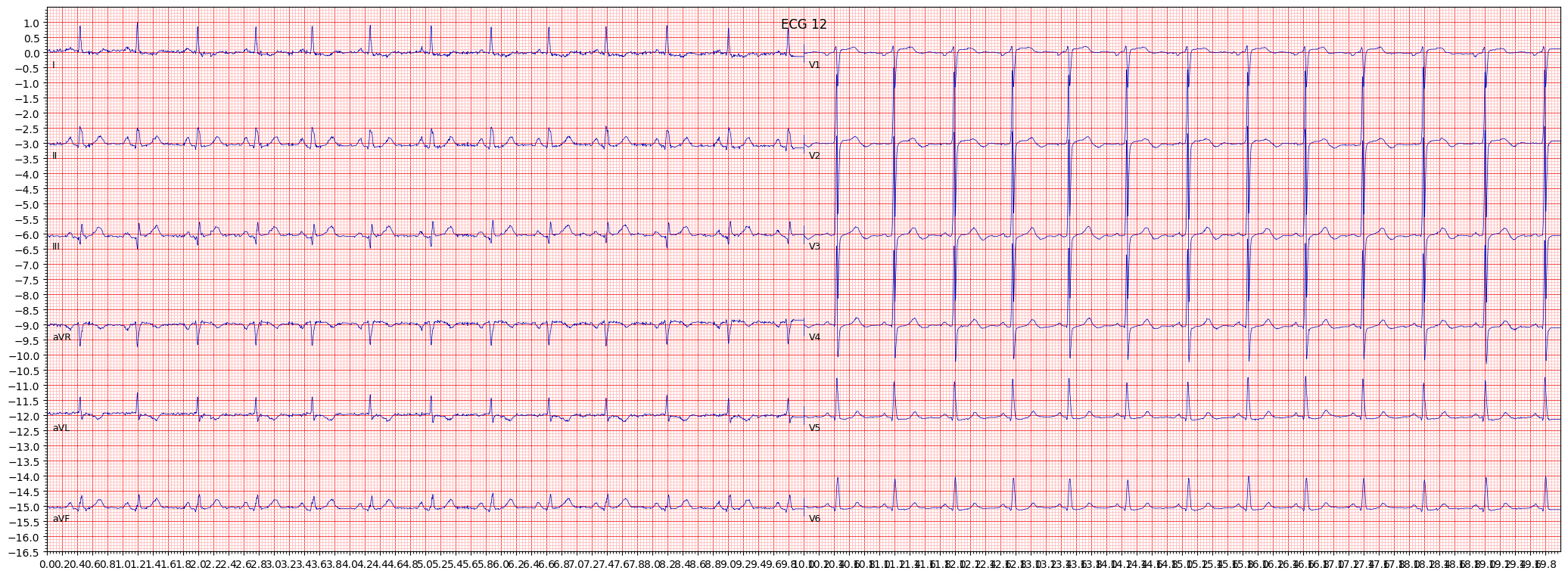 left ventricular hypertrophy (LVH) example 4199