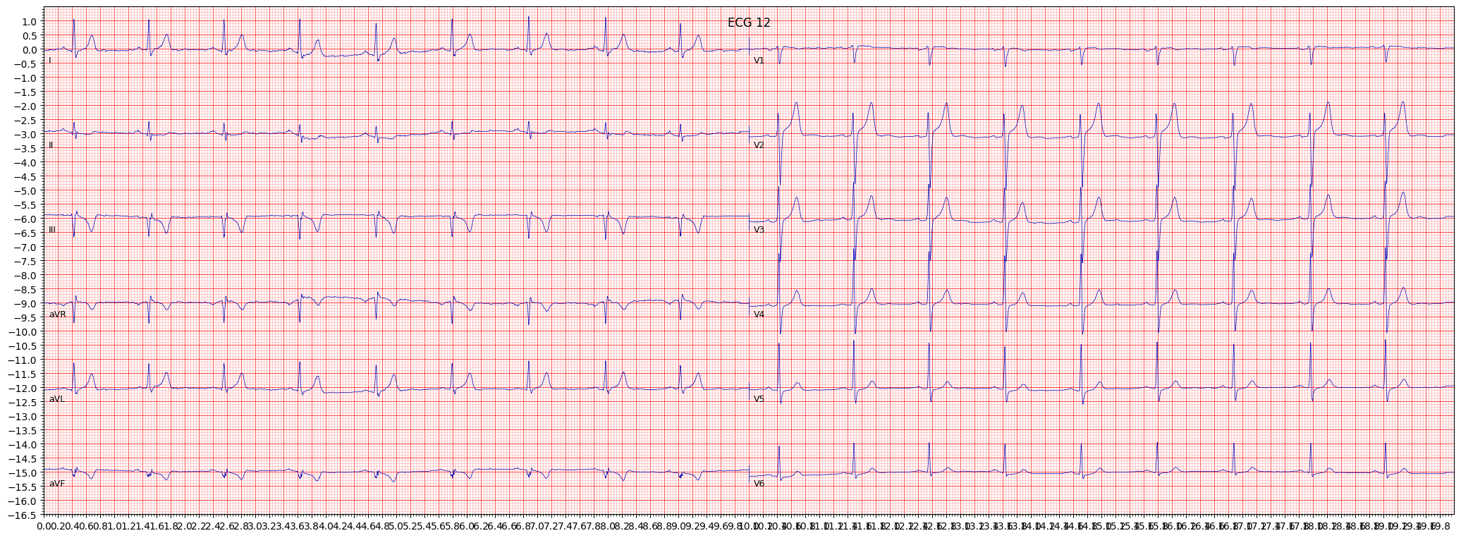 ECG example image