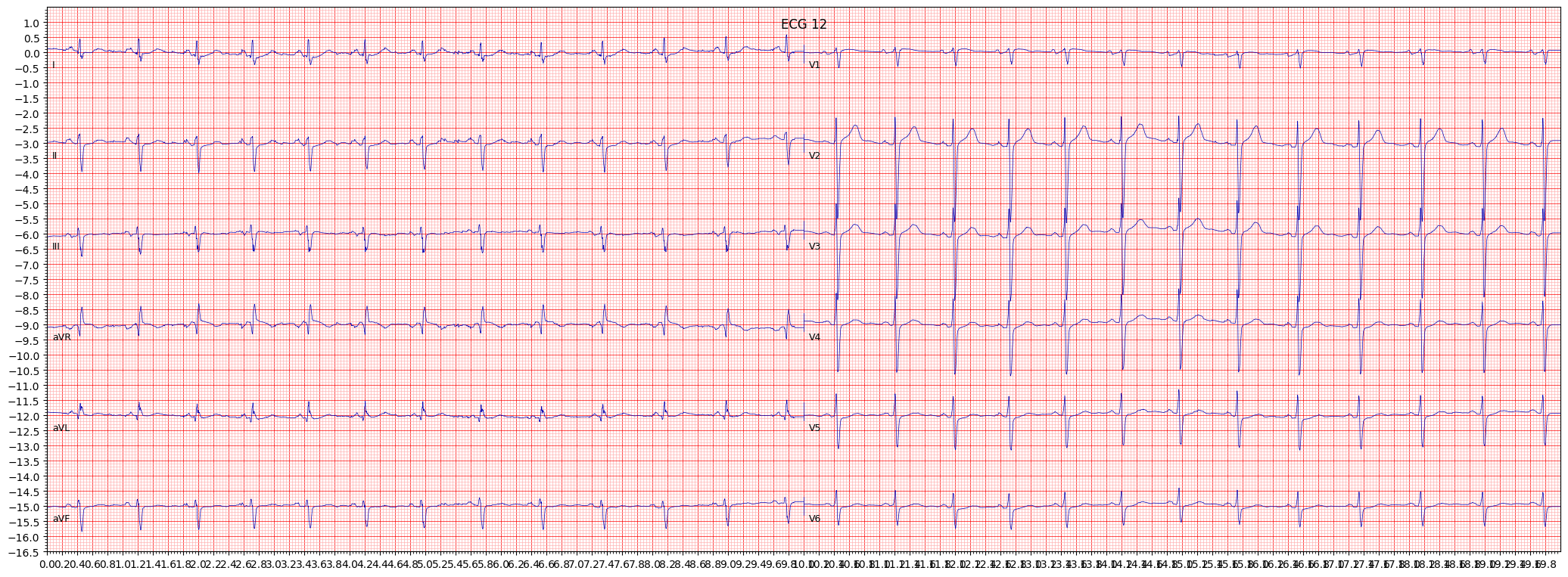 left anterior fascicular block (LAFB) example 447