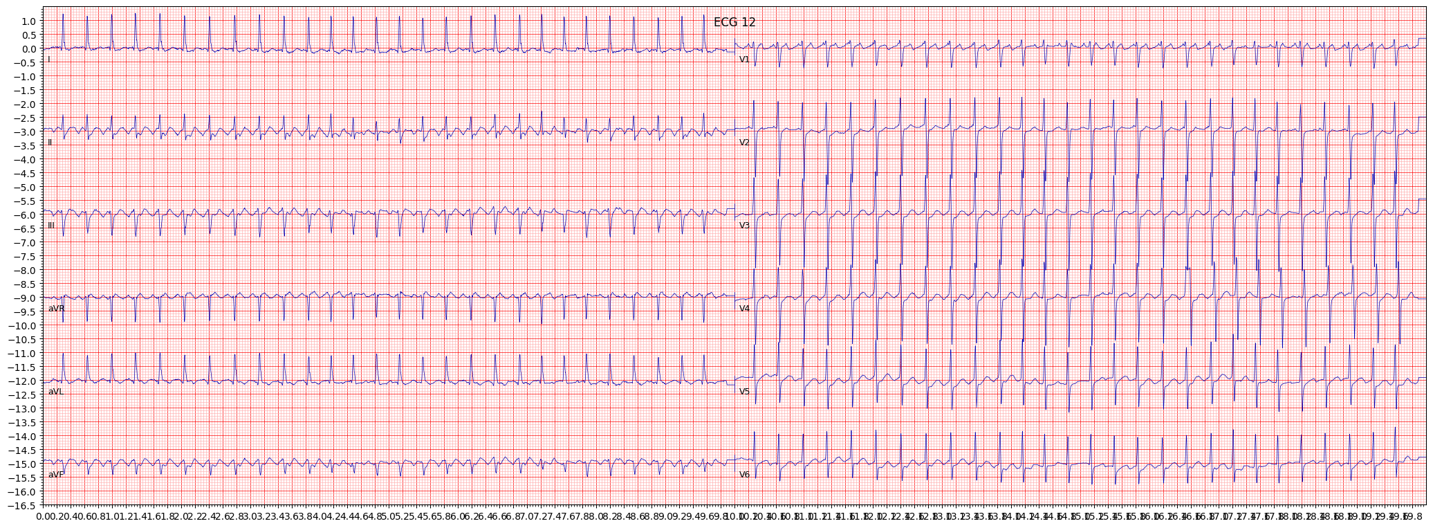 atrial futter (AFLT) example 449