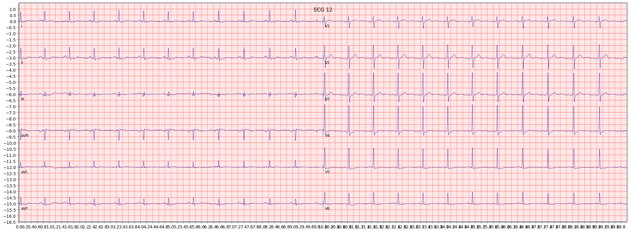 ischemic in inferolateral leads (ISCIL) example 4501