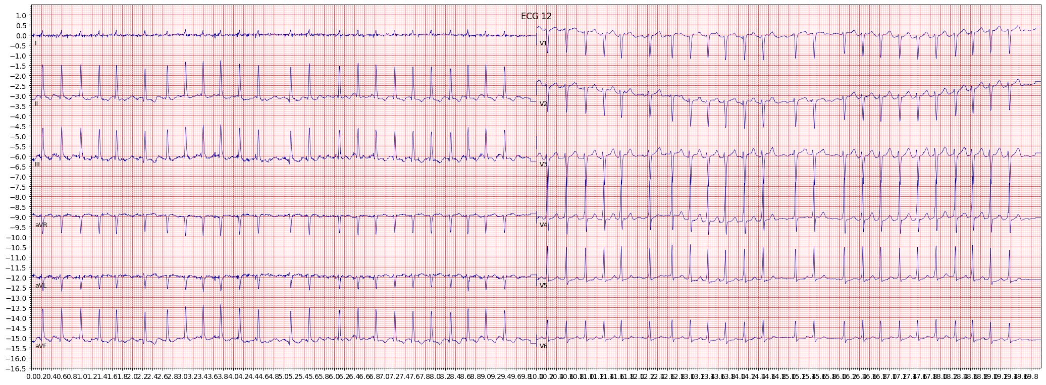 ischemic in inferior leads (ISCIN) example 4769