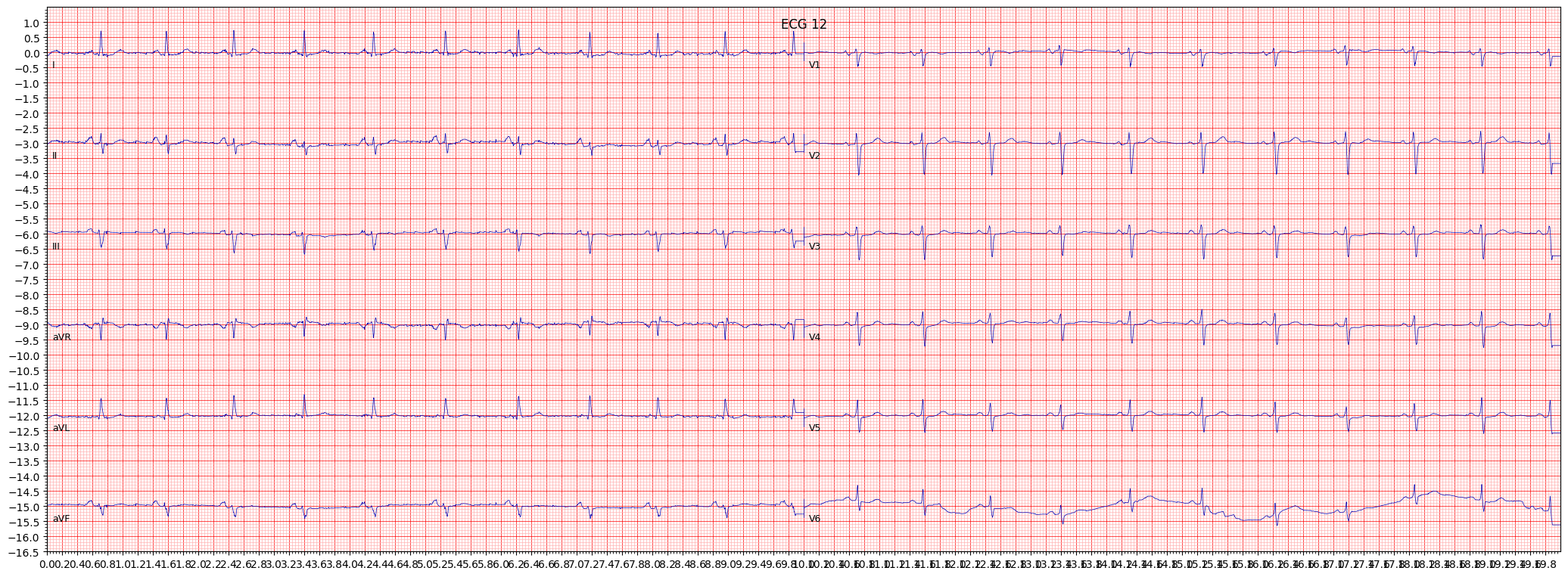 left anterior fascicular block (LAFB) example 479