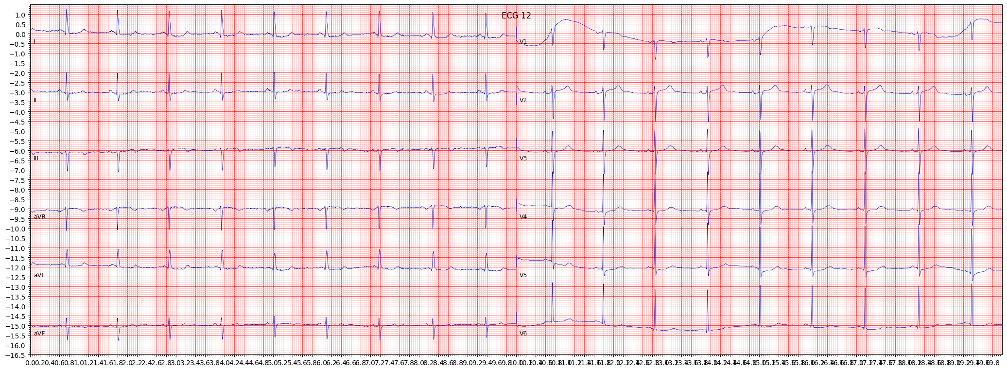 non-diagnostic T abnormalities (NDT) example 484