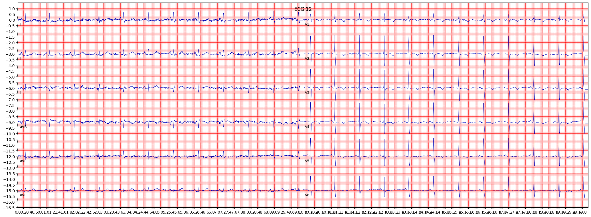 ischemic in anteroseptal leads (ISCAS) example 4964