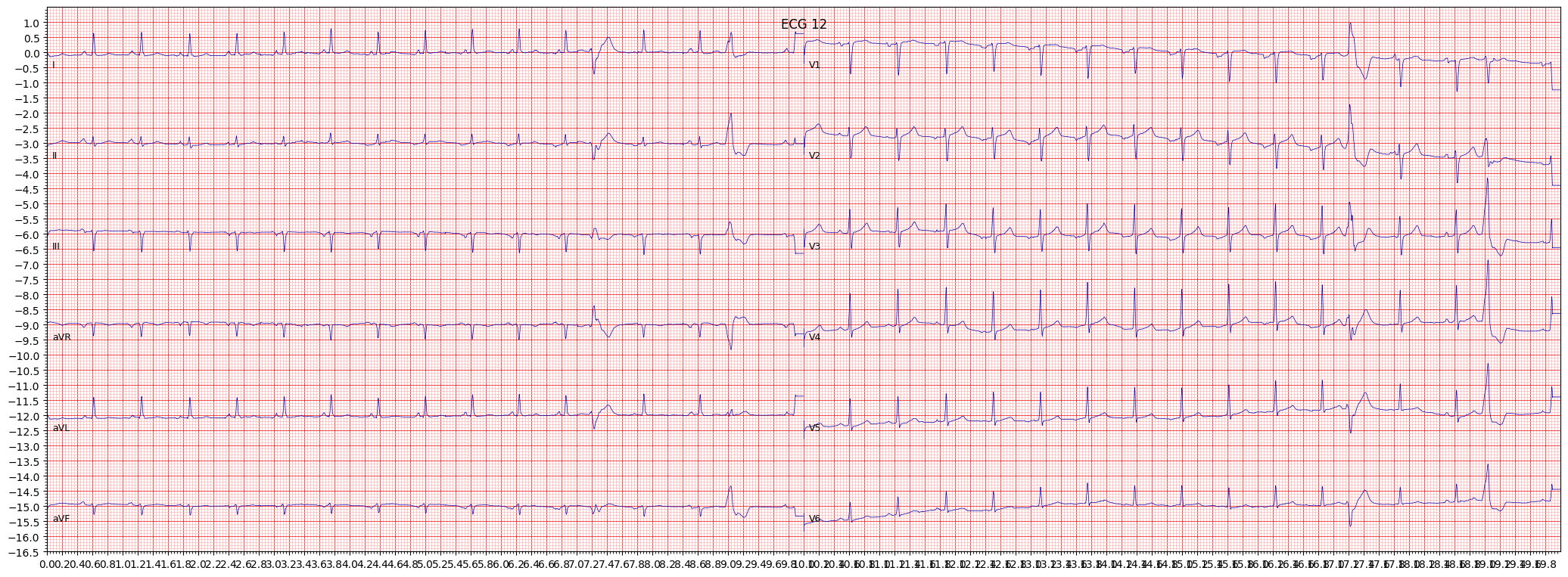 non-diagnostic T abnormalities (NDT) example 503