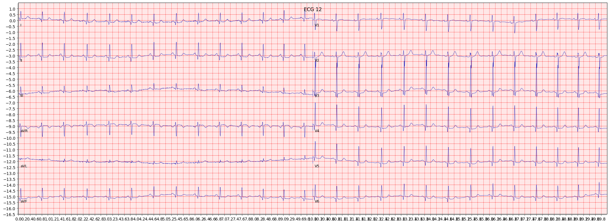 septal hypertrophy (SEHYP) example 5105