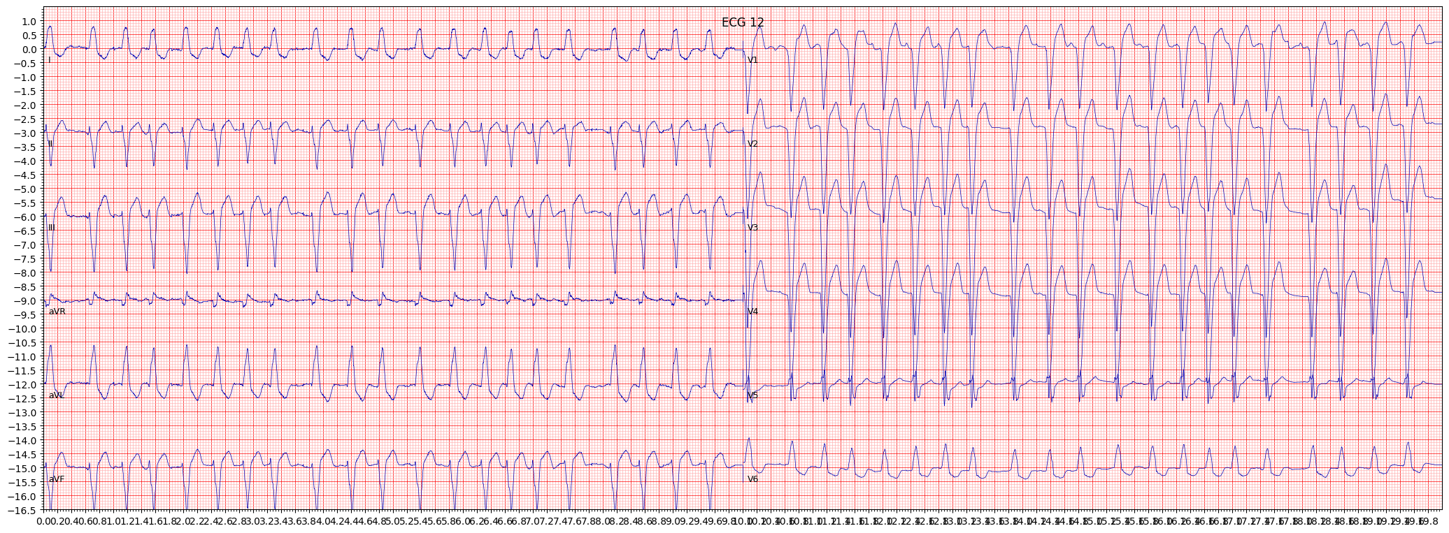 complete left bundle branch block (CLBBB) example 517
