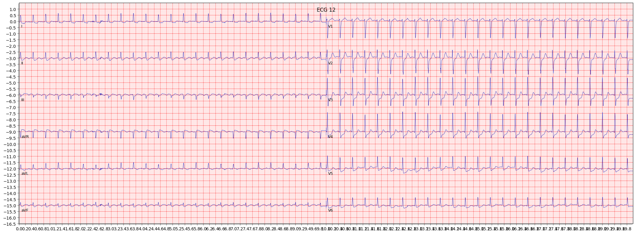 atrial futter (AFLT) example 5252