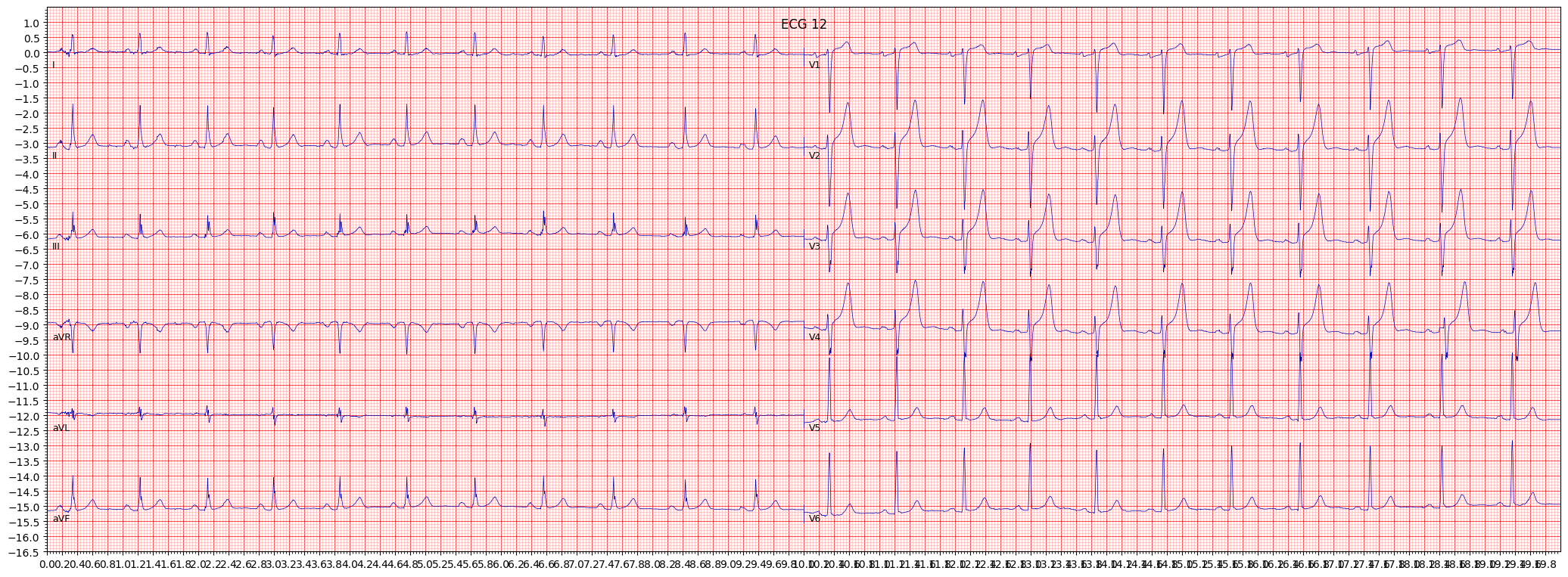 left ventricular hypertrophy (LVH) example 542