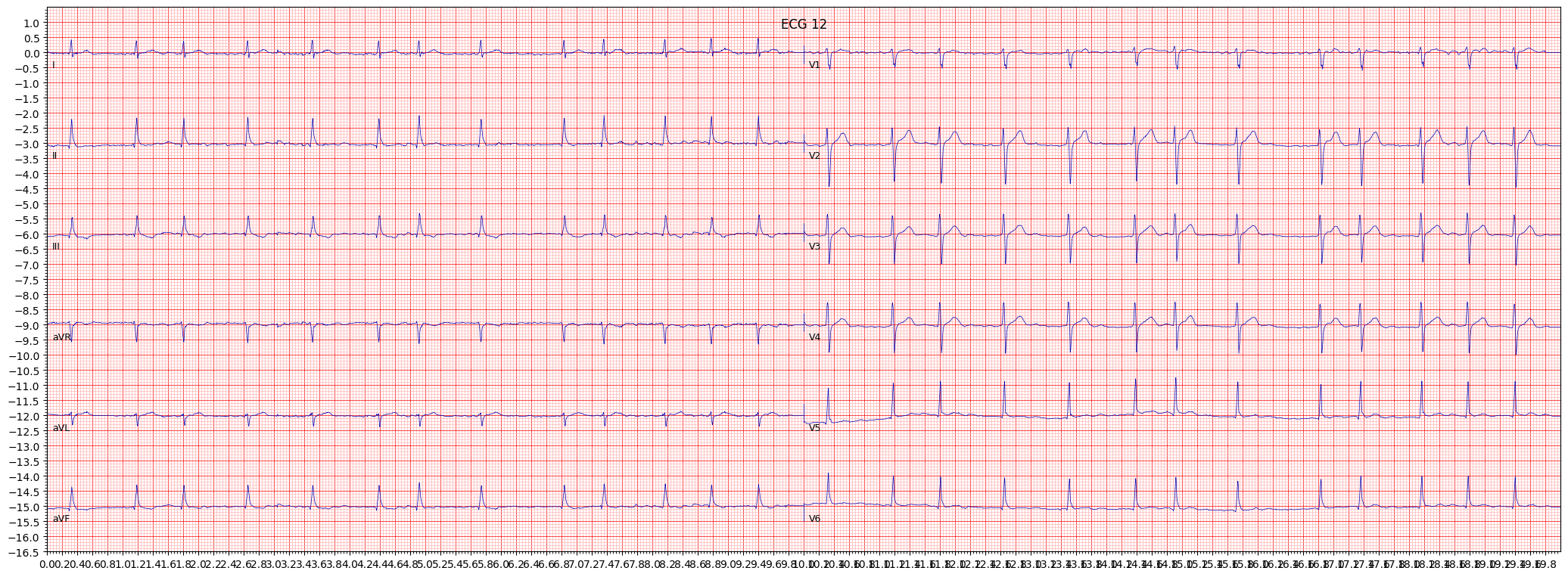 ischemic in inferior leads (ISCIN) example 557