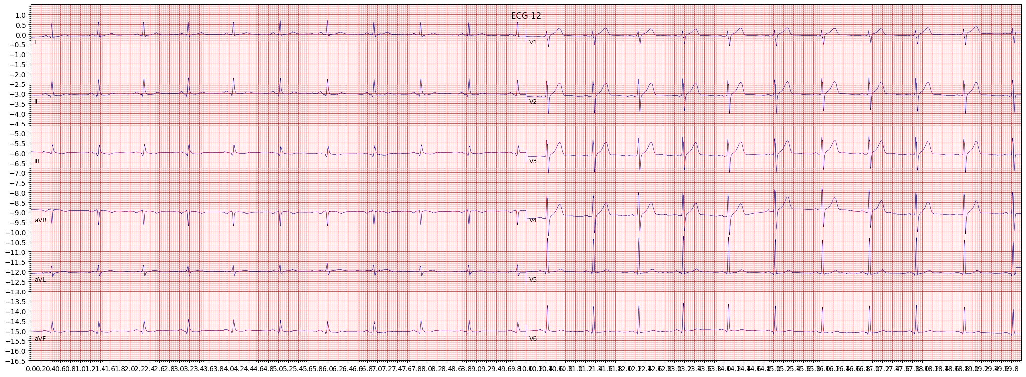 non-specifc ST changes (NST_) example 562