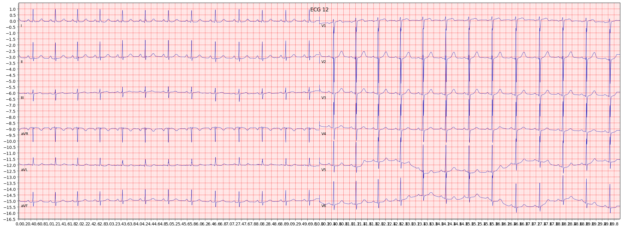 non-specifc ST changes (NST_) example 571
