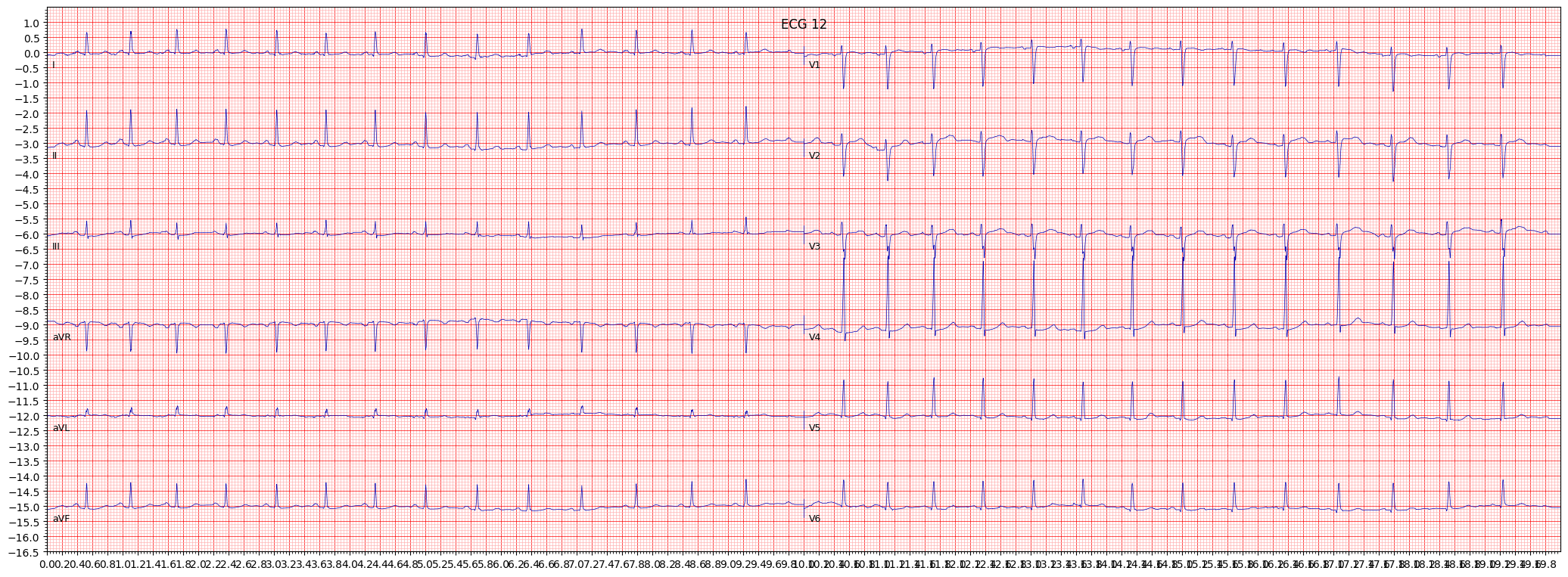 non-specifc ST changes (NST_) example 576