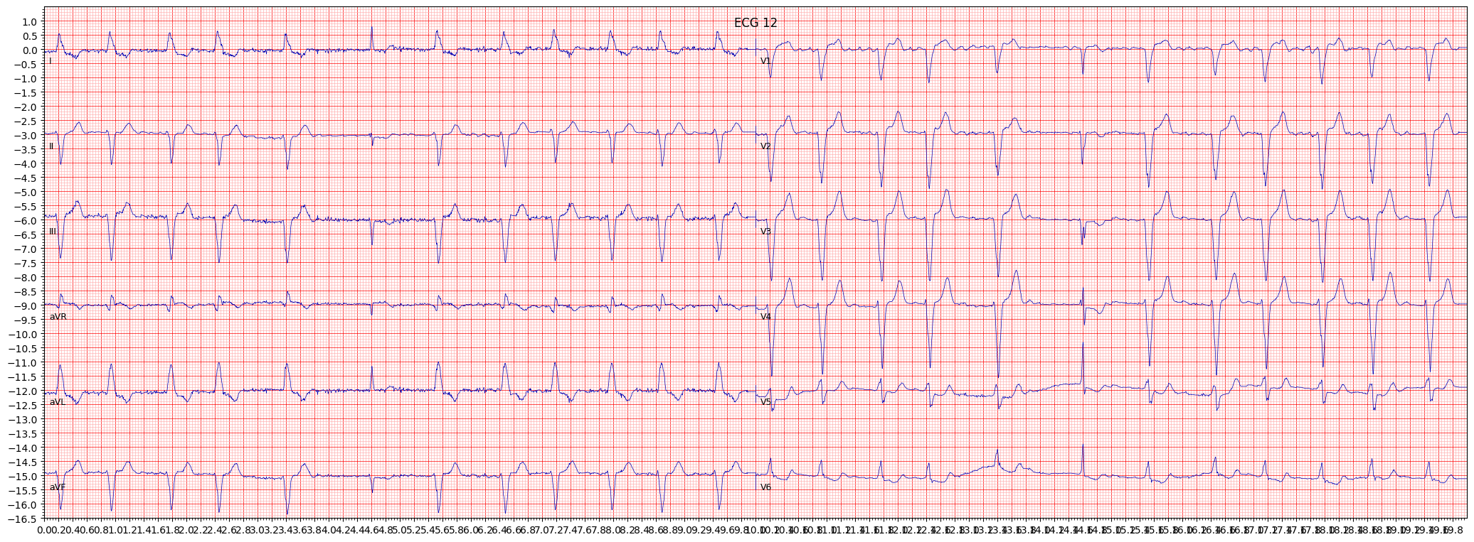 complete left bundle branch block (CLBBB) example 598