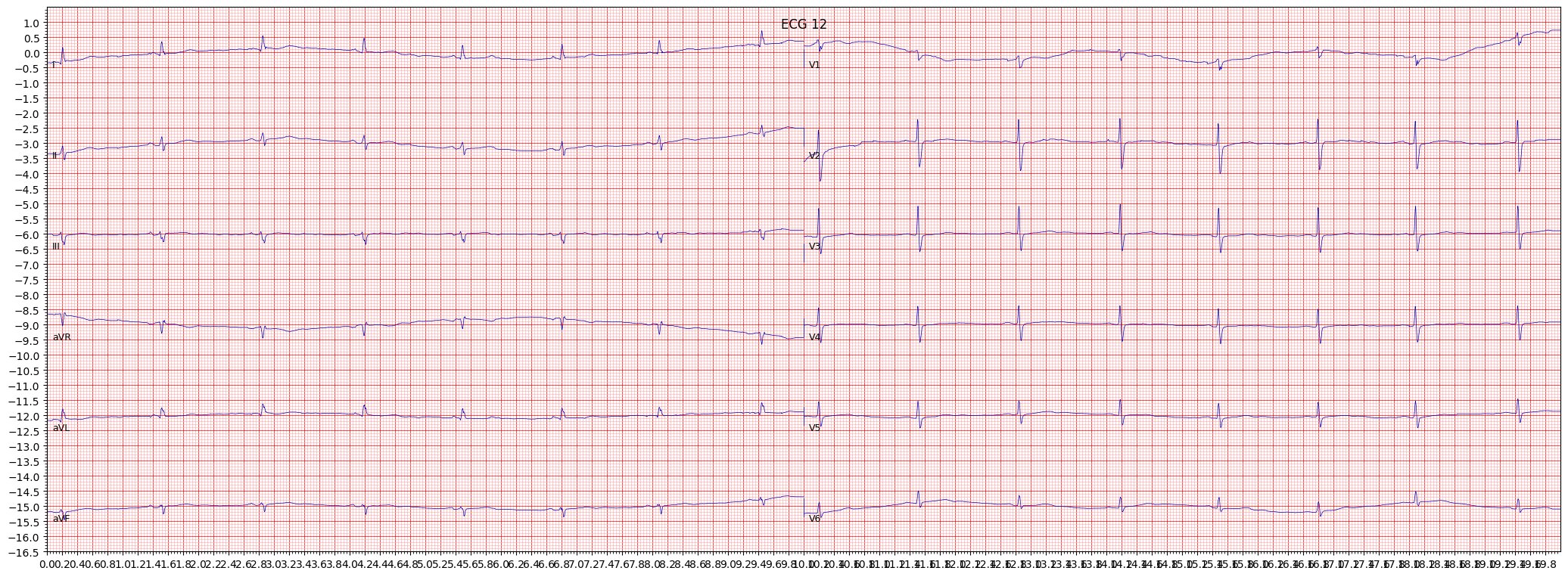 non-diagnostic T abnormalities (NDT) example 612