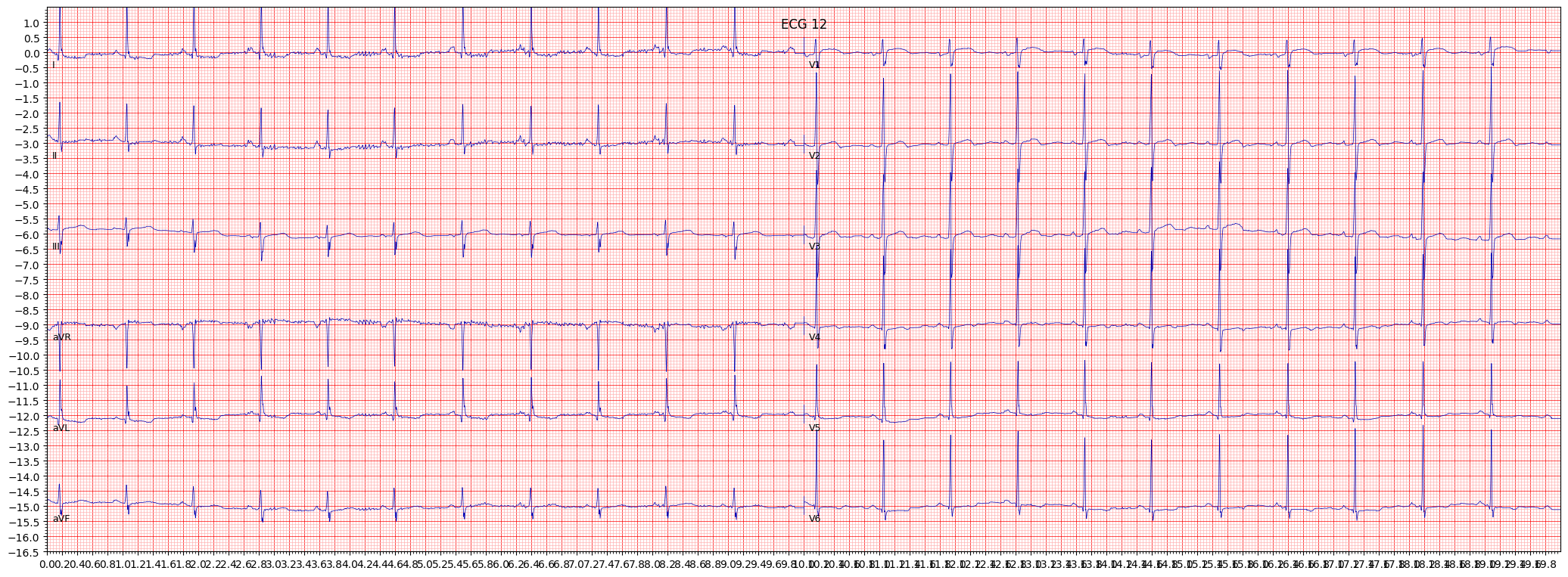 ischemic in anterolateral leads (ISCAL) example 613