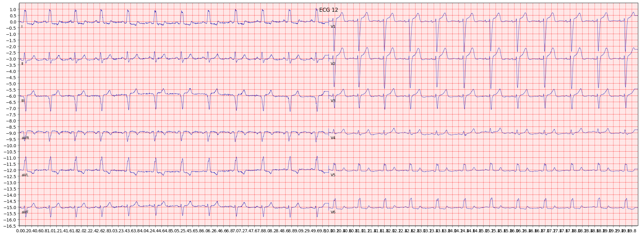 complete left bundle branch block (CLBBB) example 618