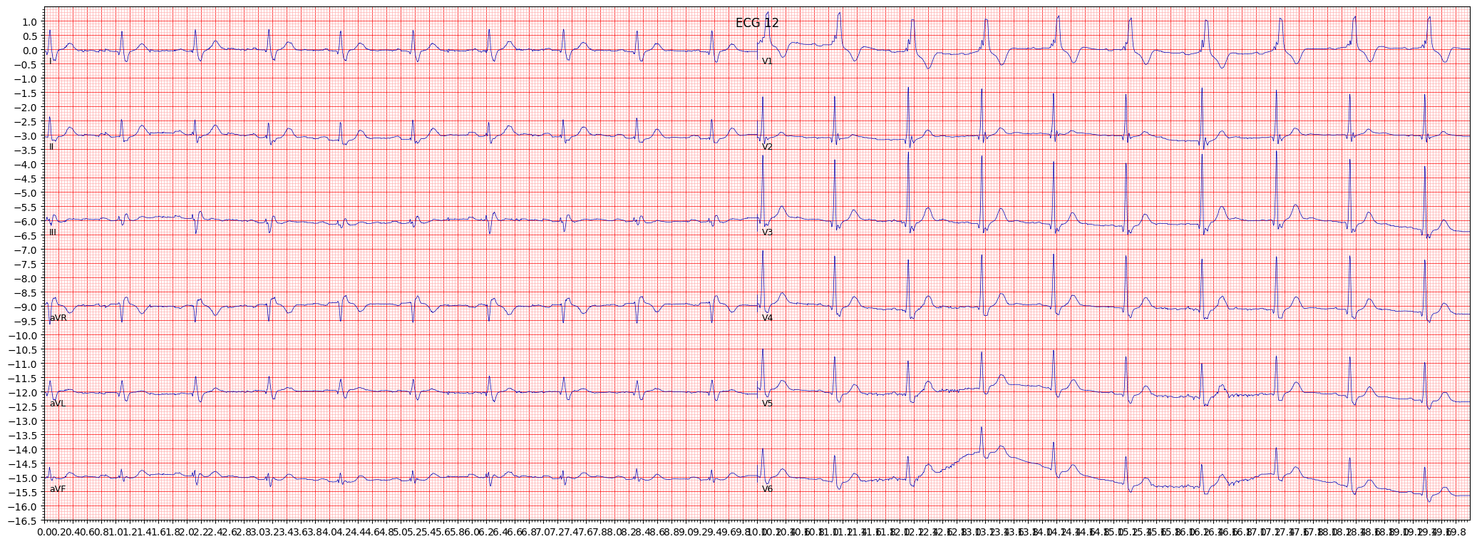 complete right bundle branch block (CRBBB) example 621