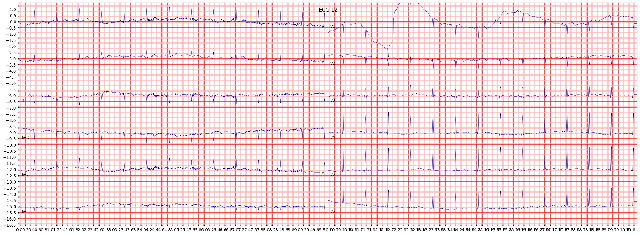 ischemic in anteroseptal leads (ISCAS) example 6297