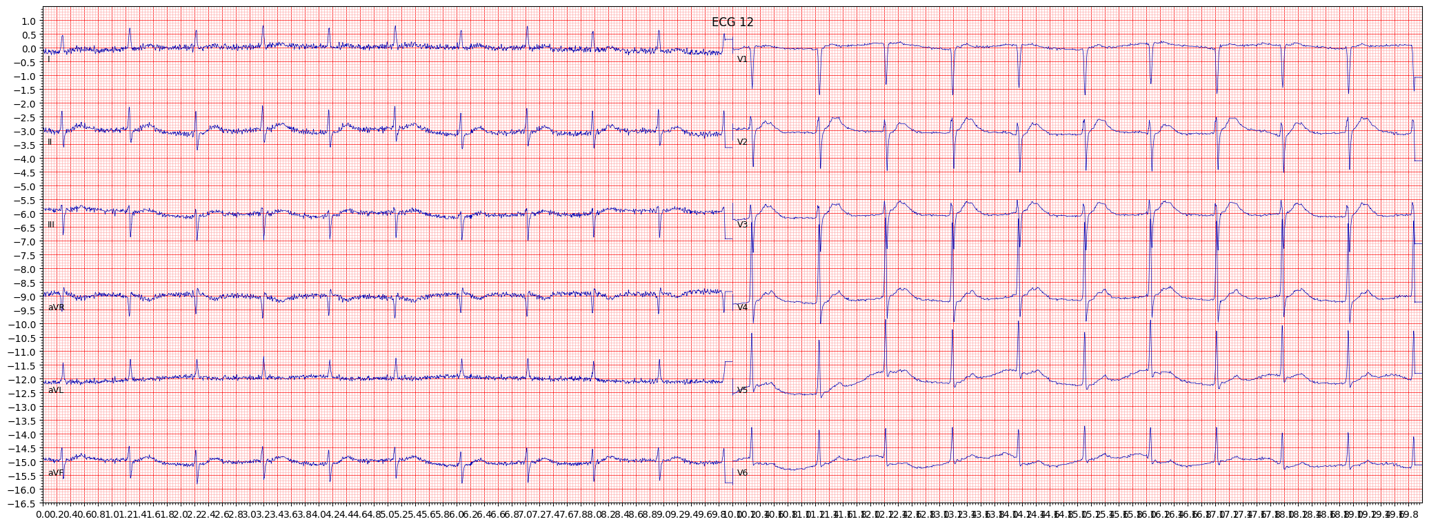 long QT-interval (LNGQT) example 6479