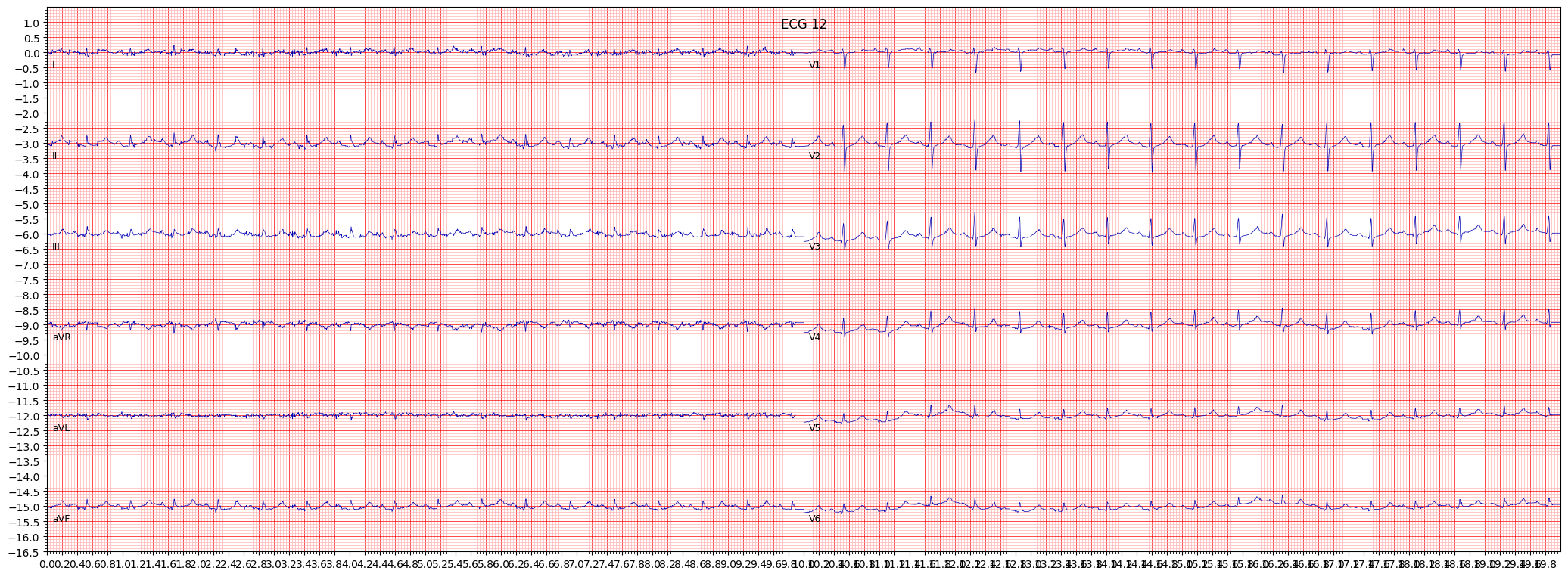long QT-interval (LNGQT) example 6515