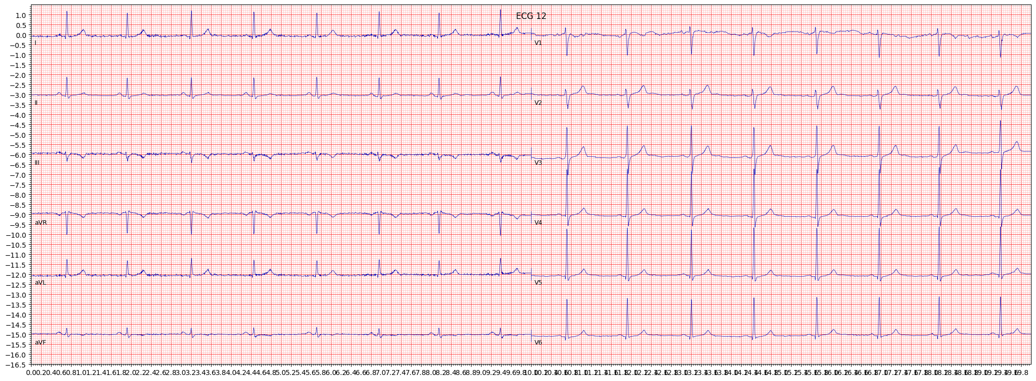 non-specifc intraventricular conduction disturbance (block) (IVCD) example 658