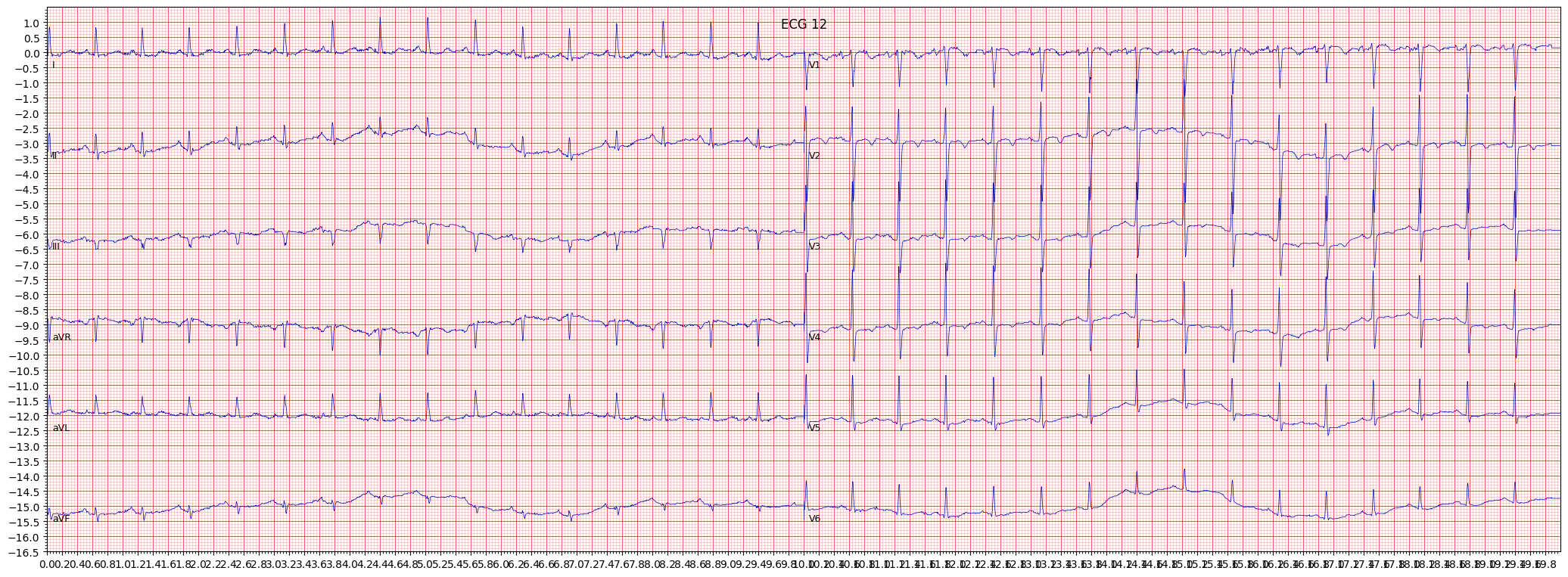 ischemic in anteroseptal leads (ISCAS) example 6631