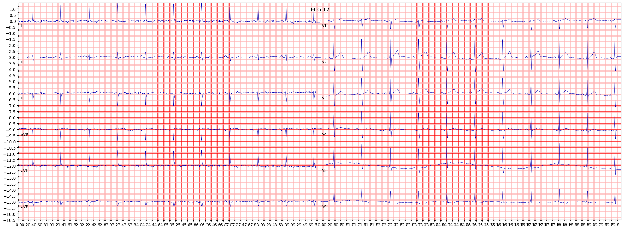 ischemic in anterolateral leads (ISCAL) example 672