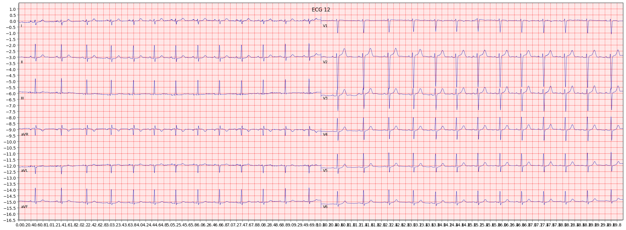 left posterior fascicular block (LPFB) example 7419
