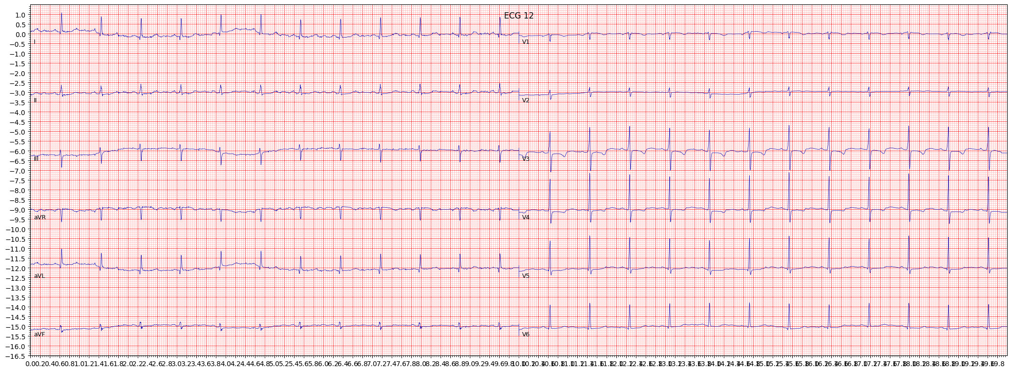 ischemic in anteroseptal leads (ISCAS) example 7810