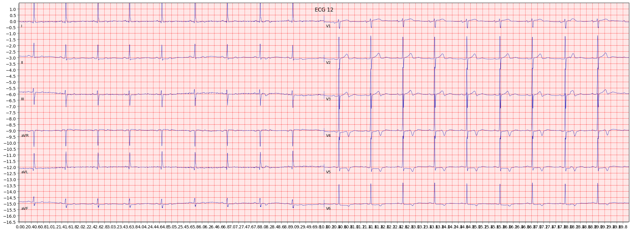 subendocardial injury in anterolateral leads (INJAL) example 7930