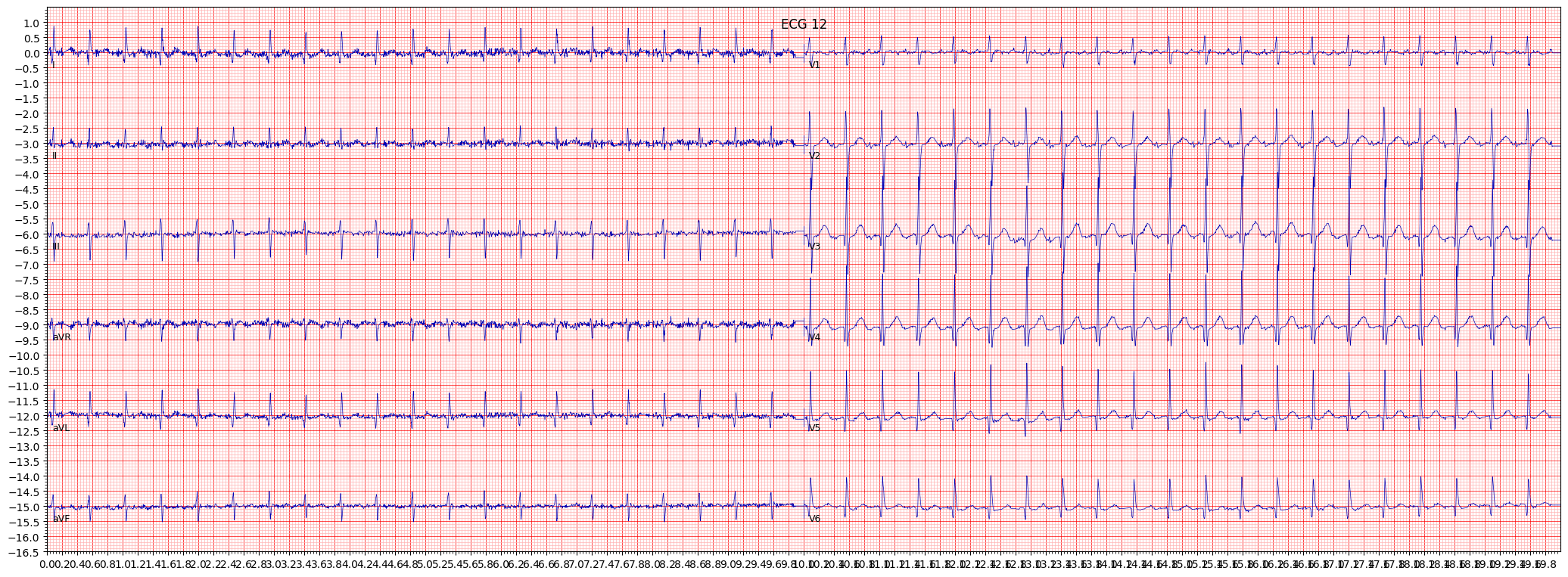 septal hypertrophy (SEHYP) example 855