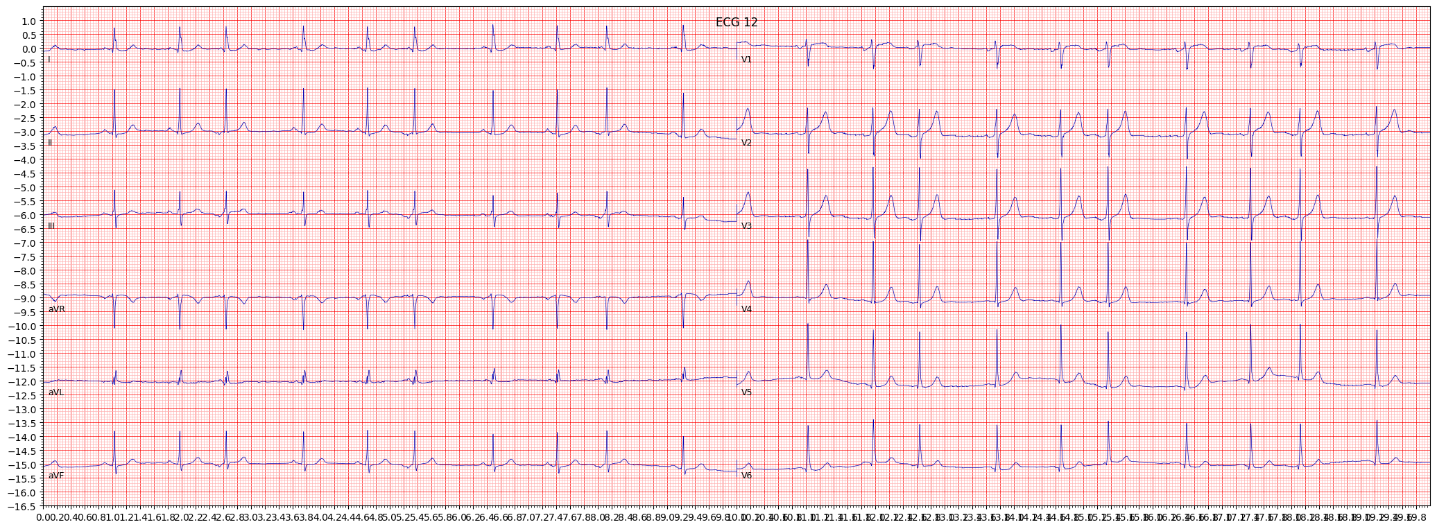 non-specifc ST changes (NST_) example 861