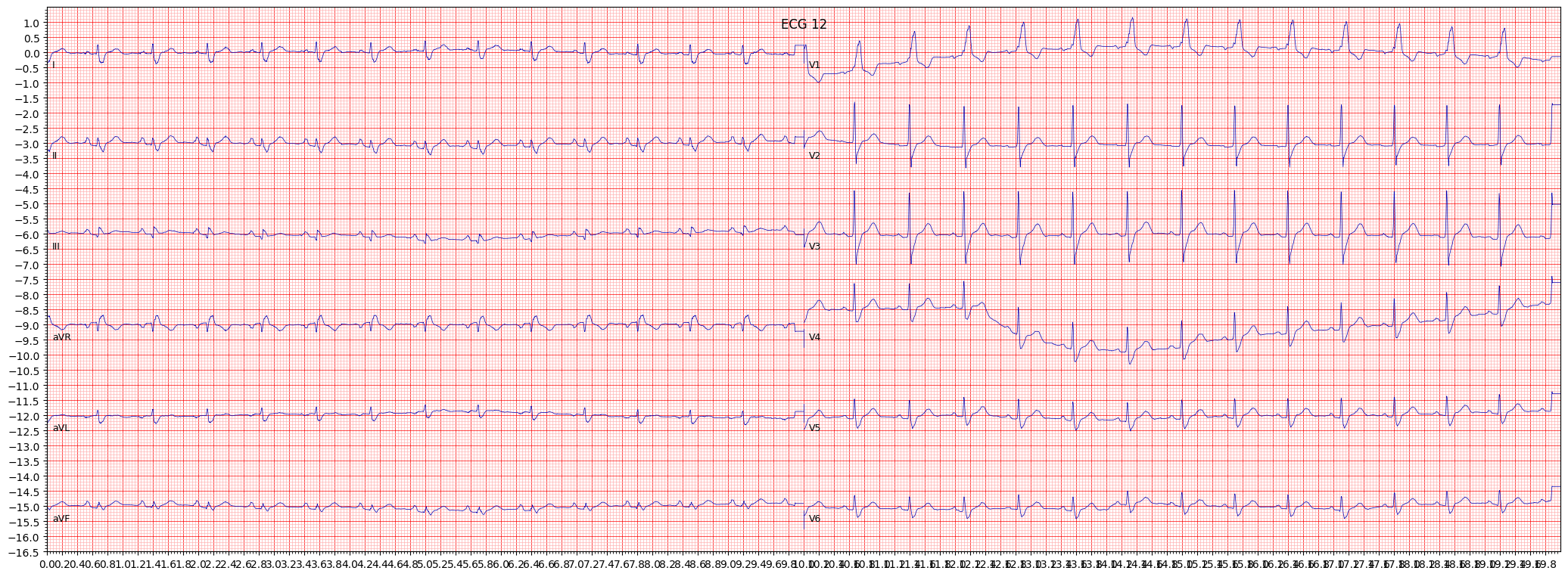 complete right bundle branch block (CRBBB) example 903