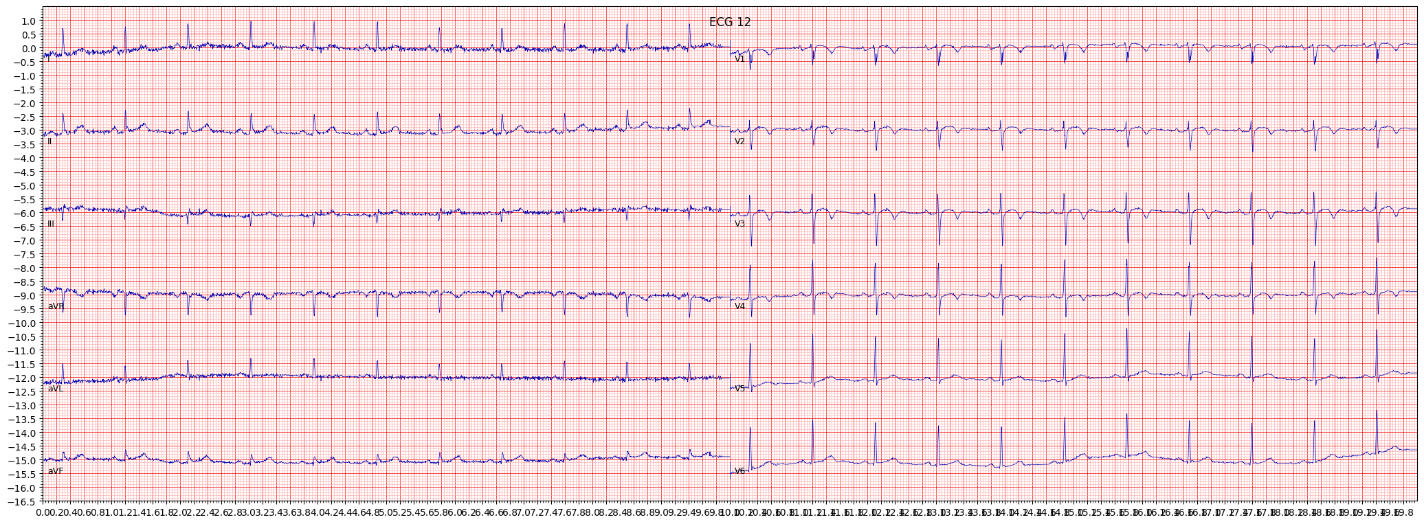 subendocardial injury in anteroseptal leads (INJAS) example 912