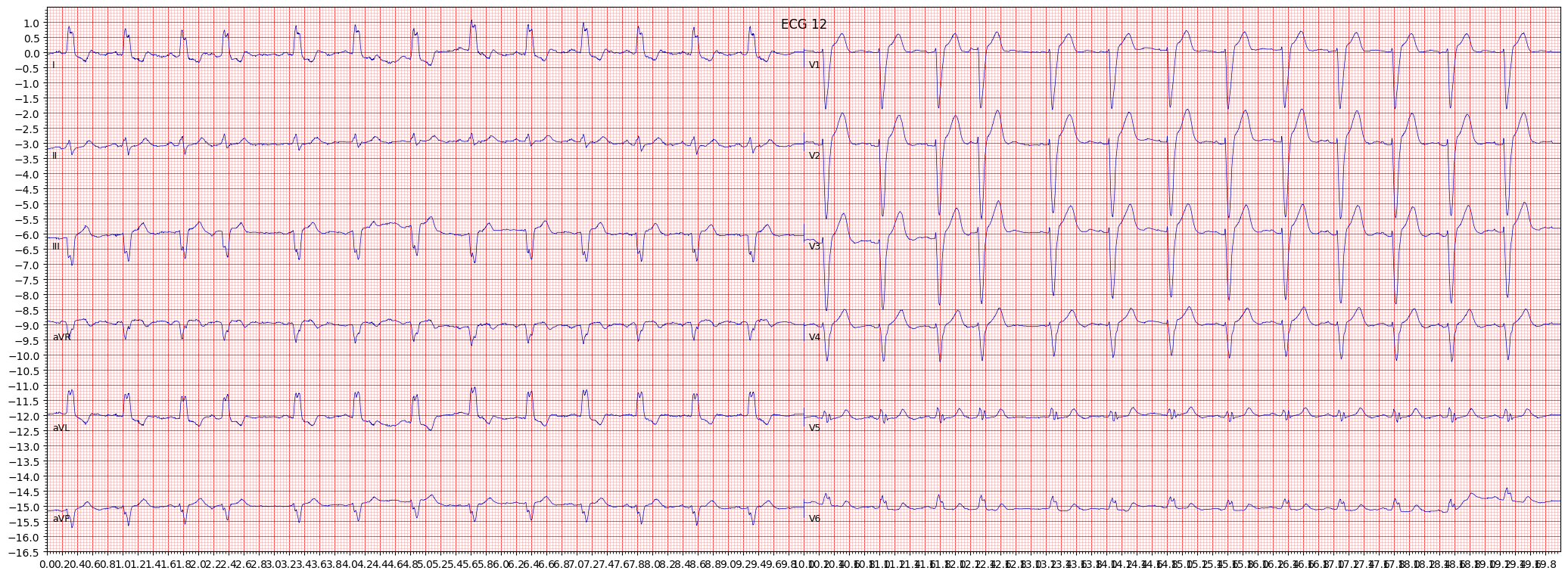 complete left bundle branch block (CLBBB) example 946