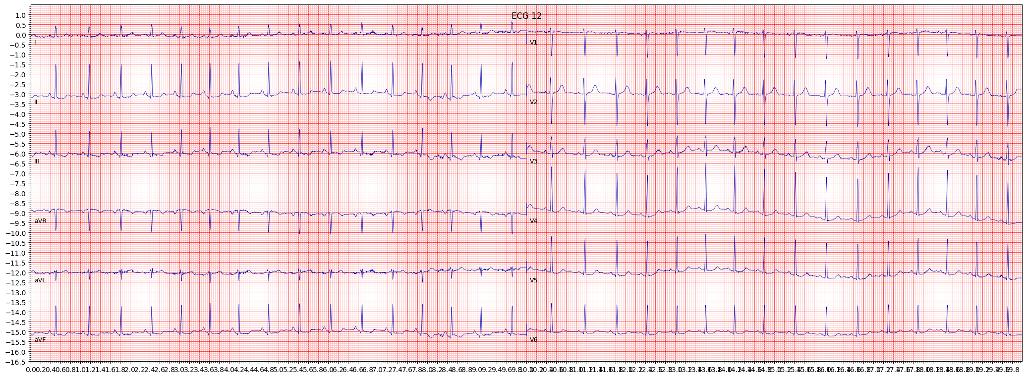 ischemic in inferior leads (ISCIN) example 9718