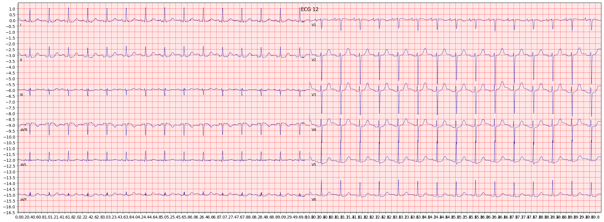 long QT-interval (LNGQT) example 9894